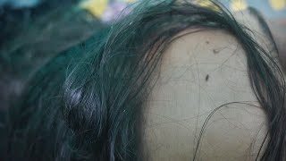 Nits and Lice Popping Sounds with Hand  Lice Infested [upl. by Nerak]