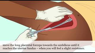 Postpartum IUD A Practical Guide [upl. by Simsar]