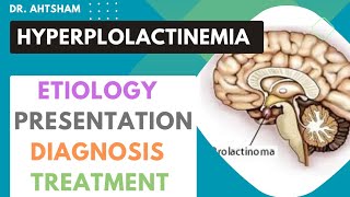 Hyperprolactinemia  increase prolactin levels [upl. by Nevah368]