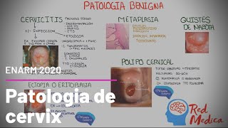 Cancer cervicouterino CaCU cervicitis y otra patología de cervix ENARM [upl. by Towroy]