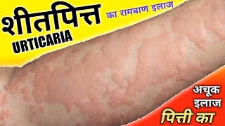 शीतपित्त पित्ती का अचूक इलाज   Urticaria Treatment  Dr Madhusudan [upl. by Alil791]