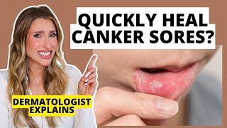 Quickly Heal Canker Sores How to Prevent amp Heal Them Faster  Dermatologist Explains [upl. by Htiekram]