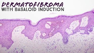 Dermatofibroma with basaloid follicular induction pathology mimic of basal cell carcinoma dermpath [upl. by Bedell]