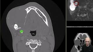 Ameloblastoma [upl. by Notsew772]