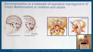 Variations in PresentationManagement of Pediatric vs Adult Chiari Malformation  Jill Plonsker MD [upl. by Parette103]