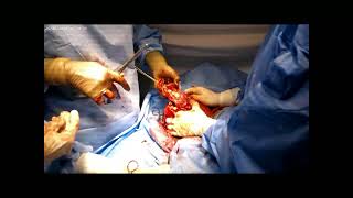 Cesarean Myomectomy By DrNikita Trehan Sunrise Hospital [upl. by Liu170]