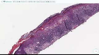 Lecture 3Lichenoid Interface Dermatitis [upl. by Deeraf]