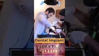 Smile Transformation Dental Implant at Cosmodent India [upl. by Donadee500]