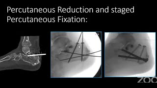 From MIS to mis Evolution of Calcaneal Fracture Management [upl. by Aitsirk]