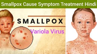 Smallpox Variola Cause Symptoms Diagnosis Treatment in Hindi  Smallpox Hindi  What is Smallpox [upl. by Ecirtael371]