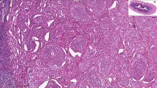 Neuroendocrine Tumor  Appendix  Histopathology [upl. by Melton]