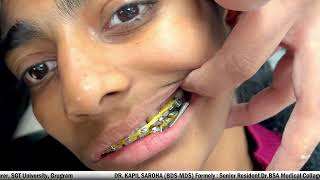 Forsus Appliance in Orthodontics  Dr Kapil Saroha BDS MDS [upl. by Rochkind704]