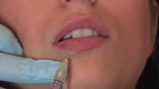 Lippenunterspritzung mit Juvederm Volbella  PULLMANN [upl. by Bradeord812]