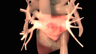 Effects of Congestive Heart Failure [upl. by Haerb810]