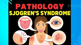 24 Sjogren Syndrome and Scleroderma [upl. by Iak554]