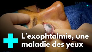 Lexophtalmie  avoir des yeux exorbités  Le Magazine de la Santé [upl. by Tirzah262]