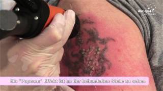 TattooStar  Trainingsvideo zur Tattooentfernung von Asclepion [upl. by Nadeau169]