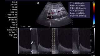 Mesenteric Artery stenosis [upl. by End]