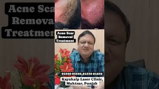 Acne Scar Removal Treatment [upl. by Ofilia770]