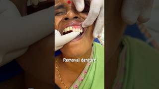 Watch how removable dentures are placed😳 viralvideo dental [upl. by Wat]