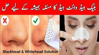 Blackheads amp Whiteheads RemovalHow to Get Rid of Blackheads amp Whiteheads Naturally [upl. by Neehcas671]