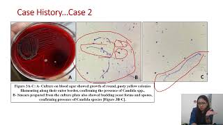 Candidiasis mimicking soft tissue lesion 2 cases at unusual location [upl. by Nedia]