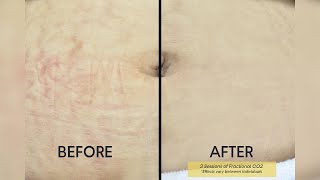 Fractional CO2 Laser Say Goodbye To Stretch Marks  Shinagawa Aesthetics [upl. by Eatnoed]