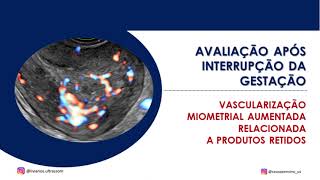 Vascularização miometrial aumentada após interrupção da gestação [upl. by Ursas806]