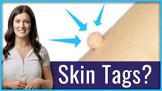 How To Remove Skin Tags ❘ TagBand [upl. by Malka]