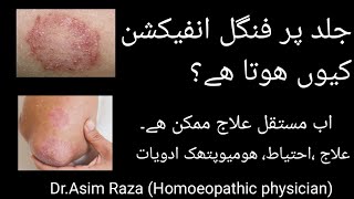 Fungal infection ka ilaj  Fungal infection treatment  Ringworm Homeopathic treatment [upl. by Leveridge698]