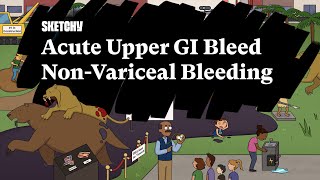 Acute Upper GI Bleed Lesson NonVariceal BleedingFull Lesson  Sketchy Medical  USMLE Step 2 CK [upl. by Otinauj]