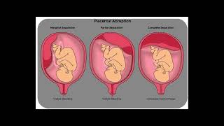 PLACENTAL ABRUPTION [upl. by Ttelrahc]