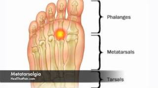 Metatarsalgia Foot Pain Causes Symptoms amp Treatments [upl. by Kneeland213]