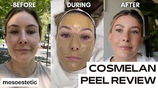 COSMELAN DEPIGMENTATION PEEL  chemical peel for pigmentation  dark spots [upl. by Ihcekn]