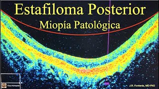 Estafiloma Posterior Miopía Patológica [upl. by Letta]