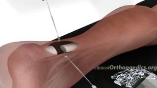 Surgical repair of a ruptured Achilles tendon [upl. by Mahsih737]