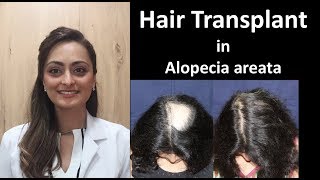 Hair Transplant in alopecia areata  recalcitrant treatment resistant [upl. by Bradlee]