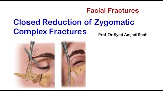 Closed Reduction of Zygomatic Complex Fractures  Oral amp Maxillofacial Surgery  Syed Amjad Shah [upl. by Nydia]