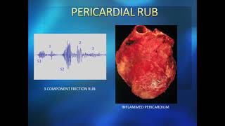 Pericarditis Pericardial Inflammation Signs amp Symptoms amp Why They Occur [upl. by Eiuqcaj]