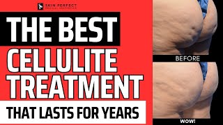 The Absolute Best Cellulite Treatment That Lasts Years [upl. by Esilram221]