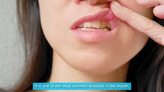 What are Canker Sores And how to treat them [upl. by Rett661]