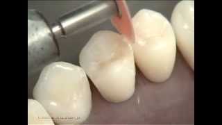 Composite Class II Preparation and Restoration on Premolar [upl. by Jamal460]