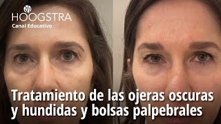 Tratamiento de las ojeras oscuras y hundidas y bolsas palpebrales  23239 [upl. by Milicent]