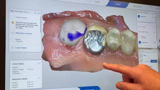 Cerec Tessera Workflow [upl. by Rairb134]