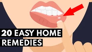 How To Get Rid Of Canker Sores FAST [upl. by Llednik]