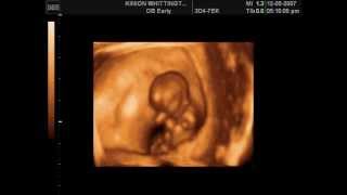 Amazing Dancing Baby in the Womb 11 Weeks [upl. by Zeena]