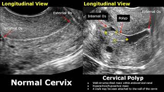 Cervix Ultrasound Normal Vs Abnormal Image Appearances  Uterus Pathologies  Gynecological USG [upl. by Llesig]