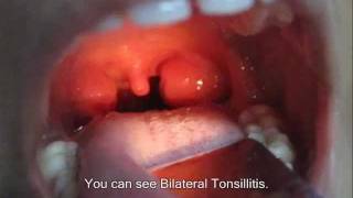 Examination Of Tonsils [upl. by Rheba139]