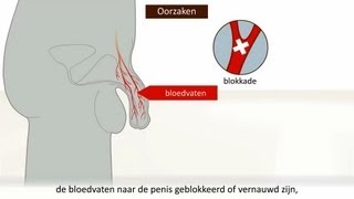 Erectiestoornis  Oorzaken en behandeling [upl. by Adnamor]