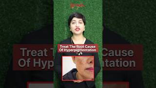 Unveiling the Truth About Hyperpigmentation Mrs Medha Singhs Expert Insights juvenaherbals [upl. by Anayia]